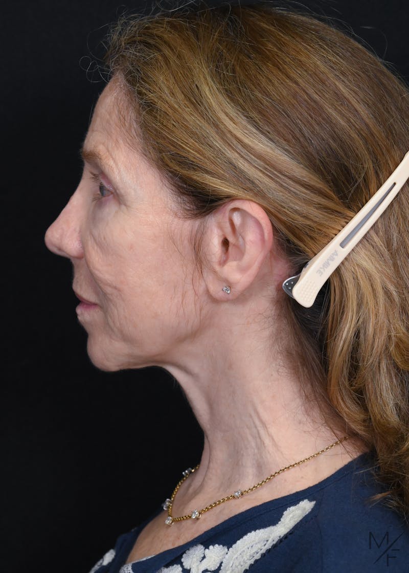Facelift Before & After Gallery - Patient 762195 - Image 5