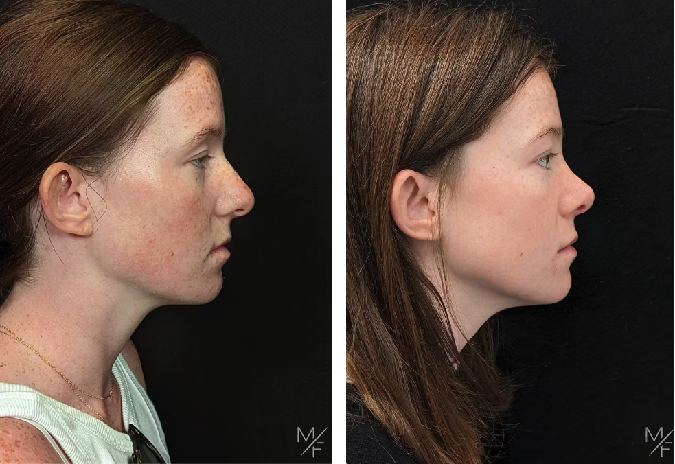 Before & After Nasal Tip Refinement