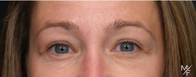 Blepharoplasty Before & After Gallery - Patient 197520 - Image 2