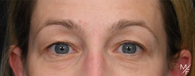 Blepharoplasty Before & After Gallery - Patient 197520 - Image 1