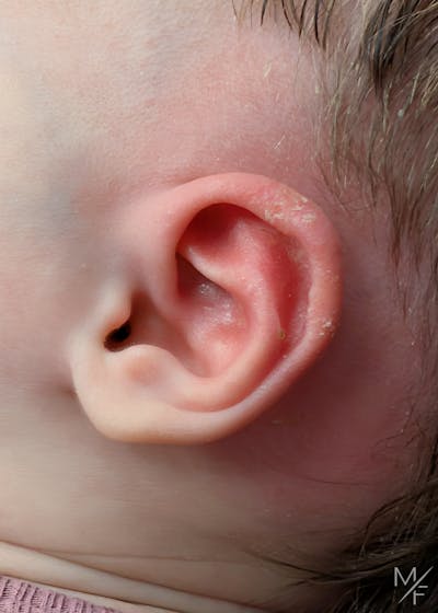 Ear Molding Before & After Gallery - Patient 179110 - Image 2