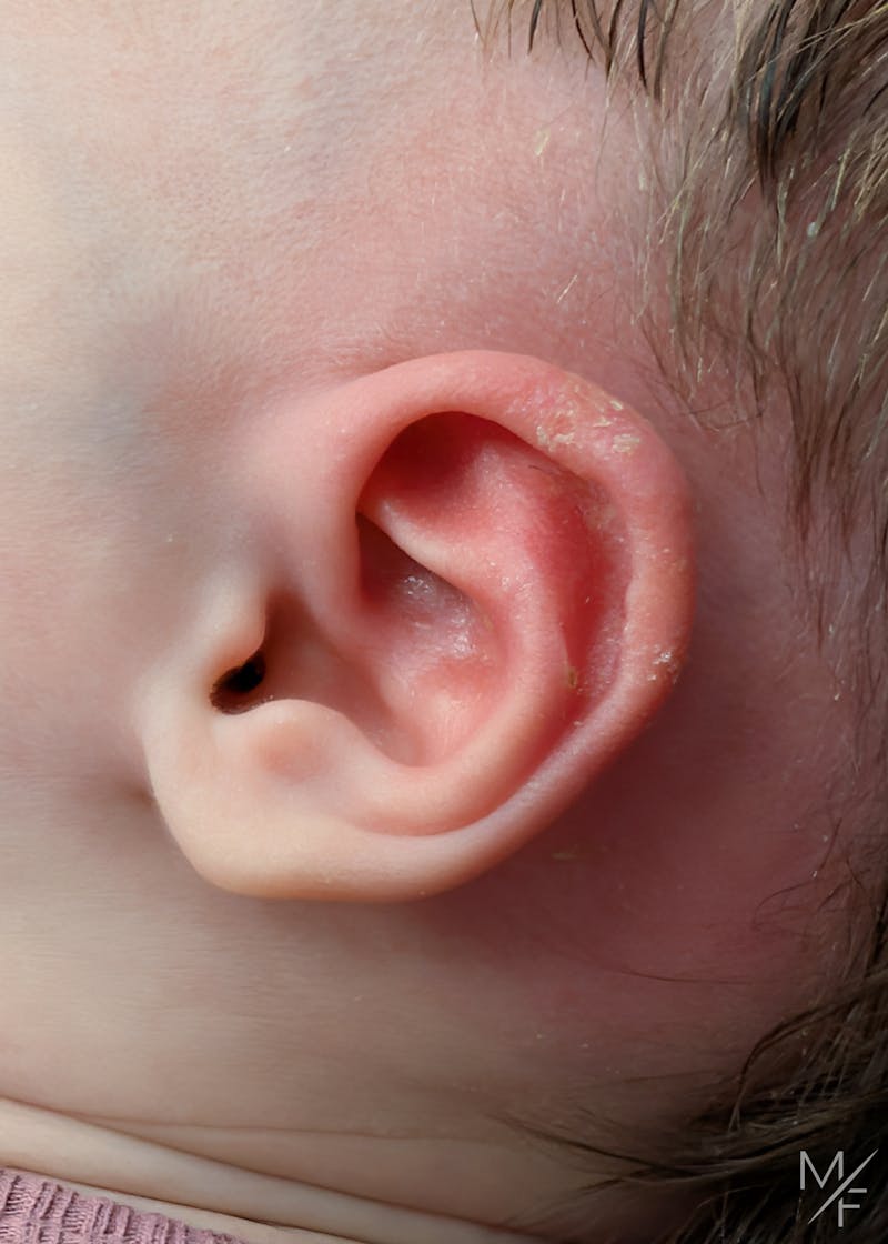 Ear Molding Before & After Gallery - Patient 179110 - Image 2