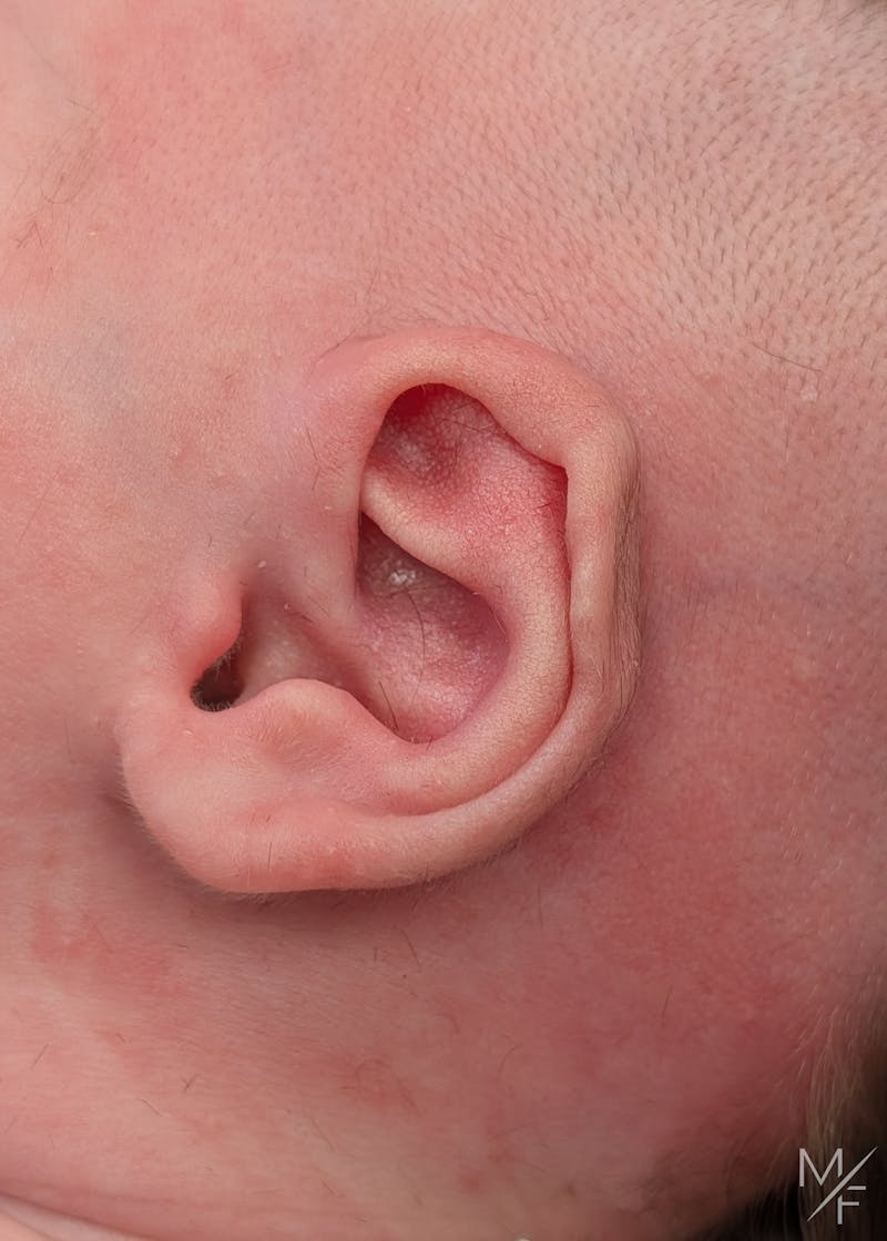 Ear Molding Before & After Gallery - Patient 179110 - Image 1