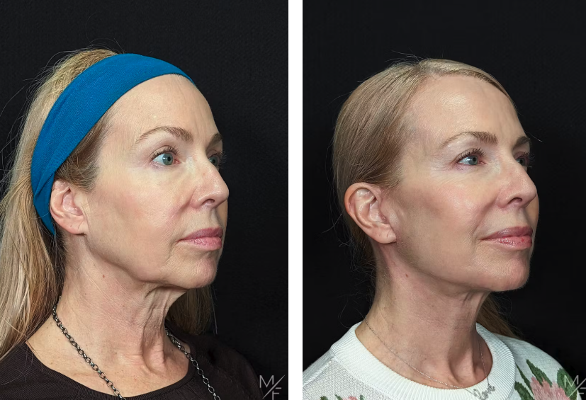 Facelift patient of Dr. Fisher
