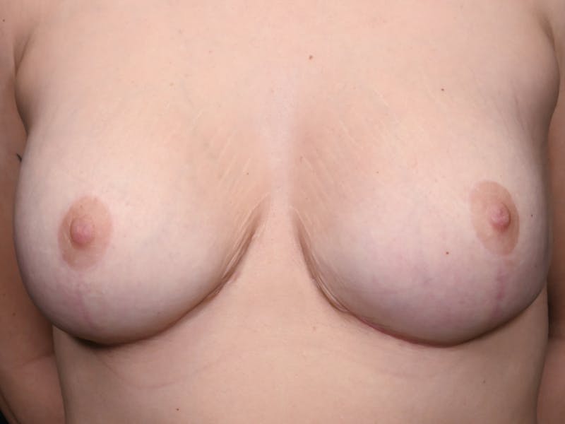 Breast Augmentation Before & After Gallery - Patient 162443 - Image 2