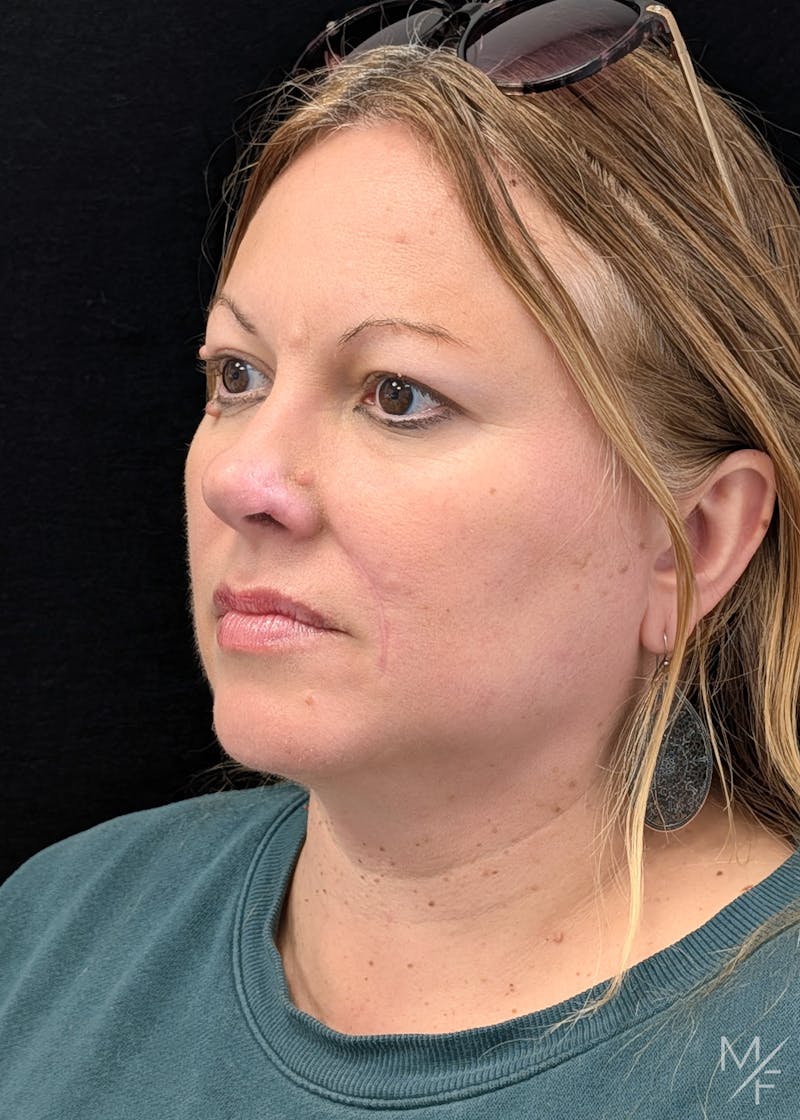 Skin Cancer Reconstruction Before & After Gallery - Patient 226214 - Image 2