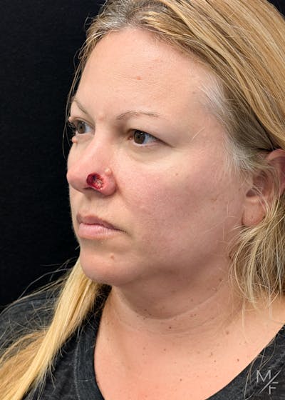 Skin Cancer Reconstruction Before & After Gallery - Patient 226214 - Image 1