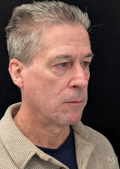 Skin Cancer Reconstruction Before & After Gallery - Patient 216101 - Image 2