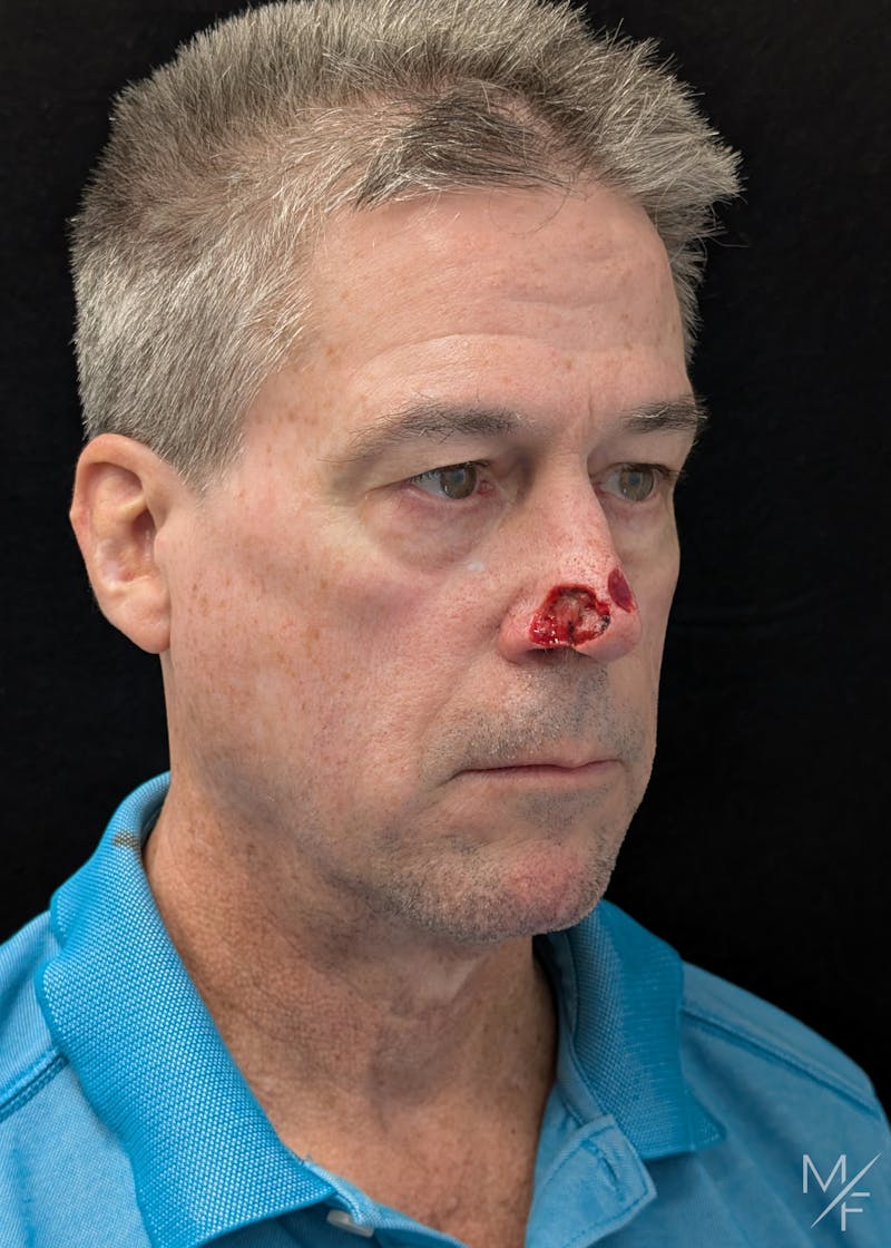 Skin Cancer Reconstruction Before & After Gallery - Patient 216101 - Image 1