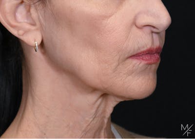Facelift Before & After Gallery - Patient 137472 - Image 1
