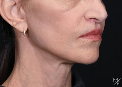 Facelift Before & After Gallery - Patient 137472 - Image 2