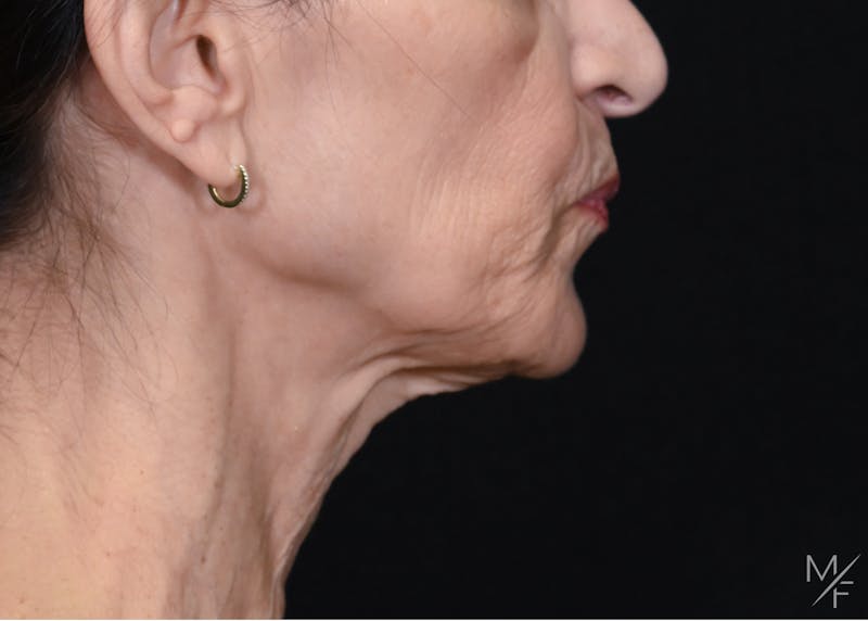 Facelift Before & After Gallery - Patient 137472 - Image 5