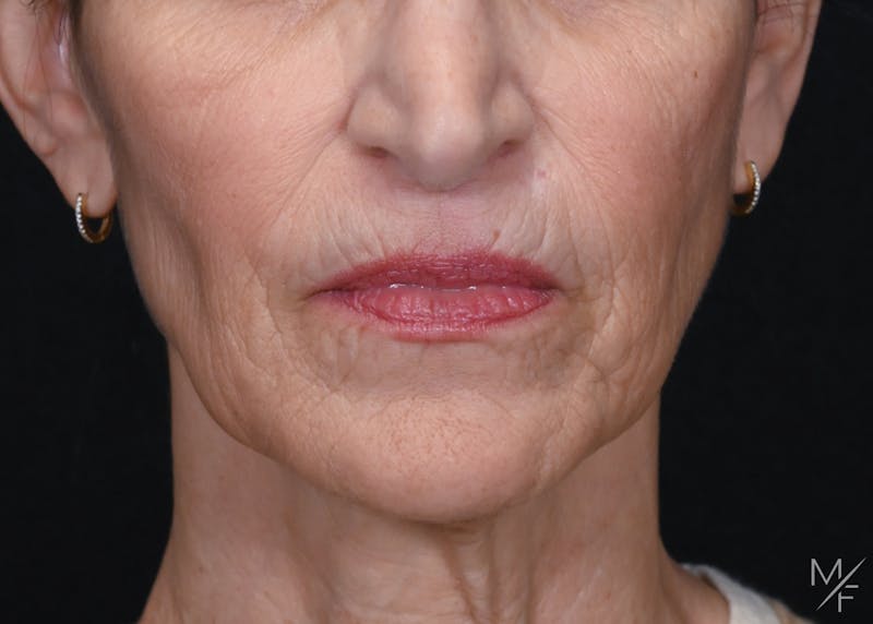 Facelift Before & After Gallery - Patient 137472 - Image 3