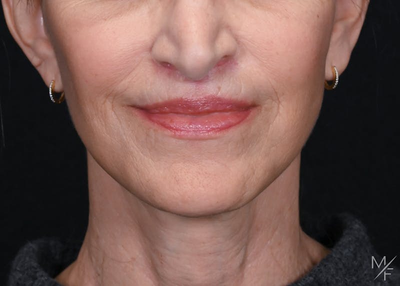Facelift Before & After Gallery - Patient 137472 - Image 4