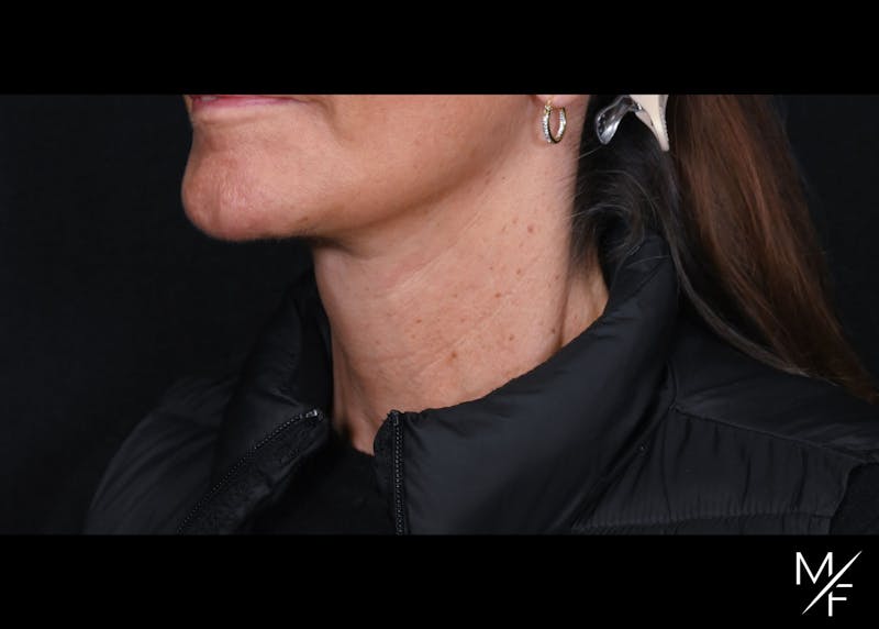 Facelift Before & After Gallery - Patient 233322 - Image 2