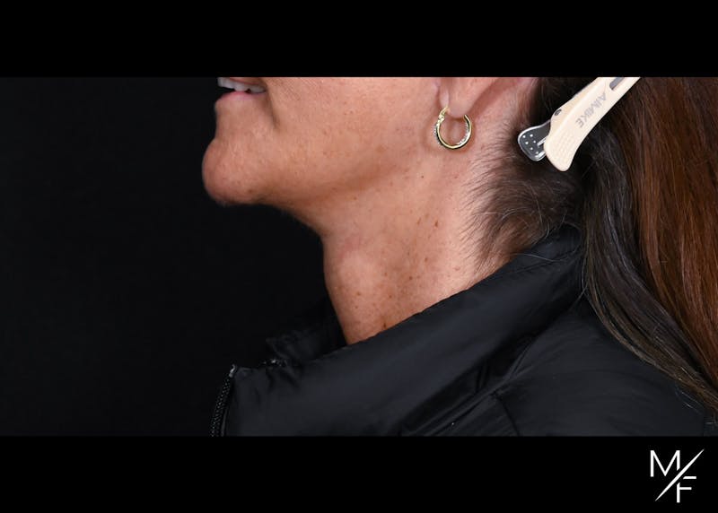 Facelift Before & After Gallery - Patient 233322 - Image 6