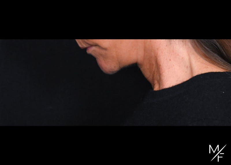 Facelift Before & After Gallery - Patient 233322 - Image 4