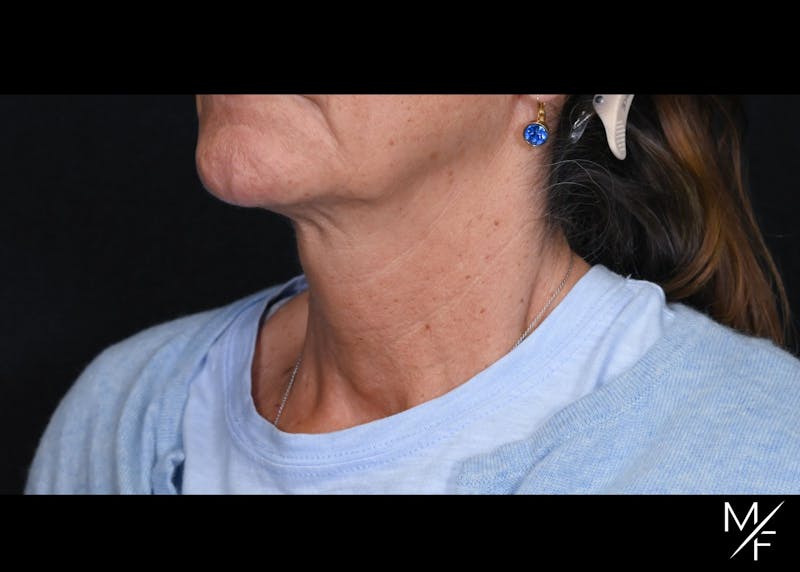 Facelift Before & After Gallery - Patient 233322 - Image 1