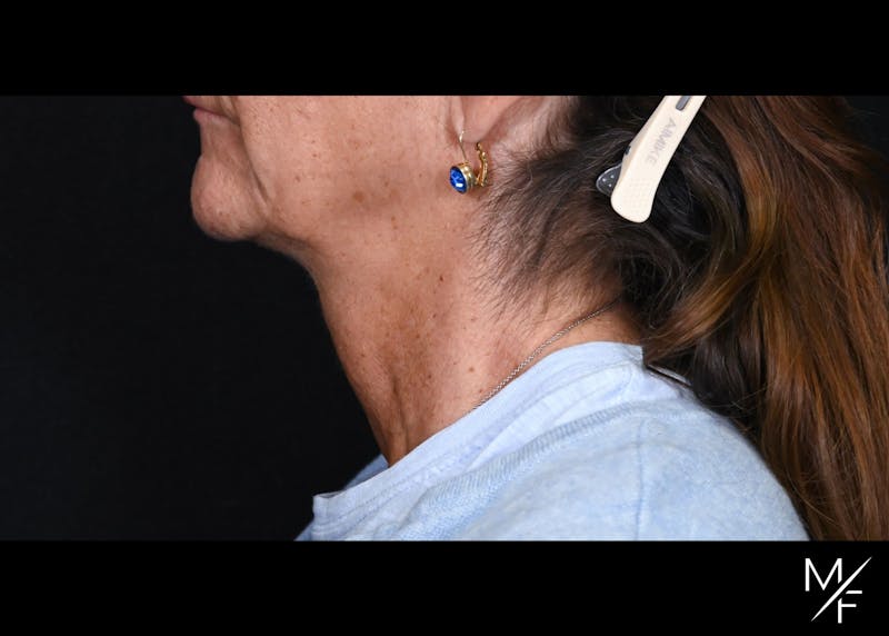 Facelift Before & After Gallery - Patient 233322 - Image 5