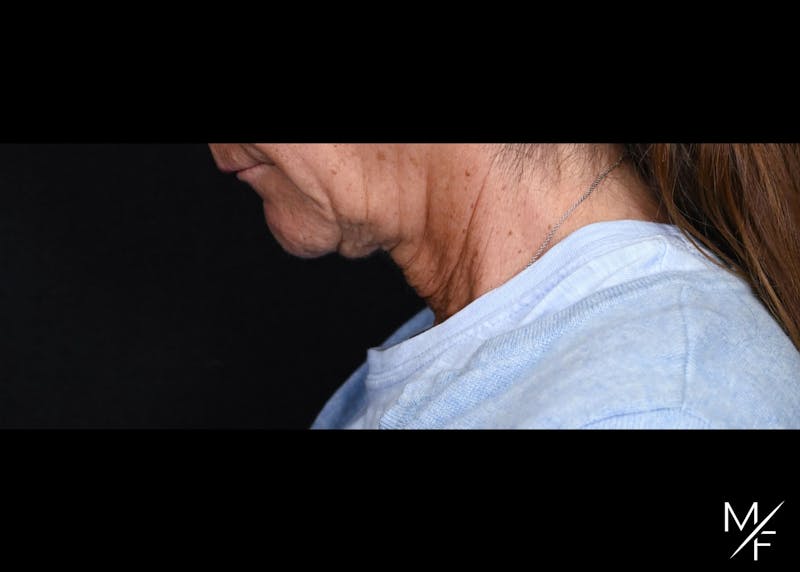 Facelift Before & After Gallery - Patient 233322 - Image 3