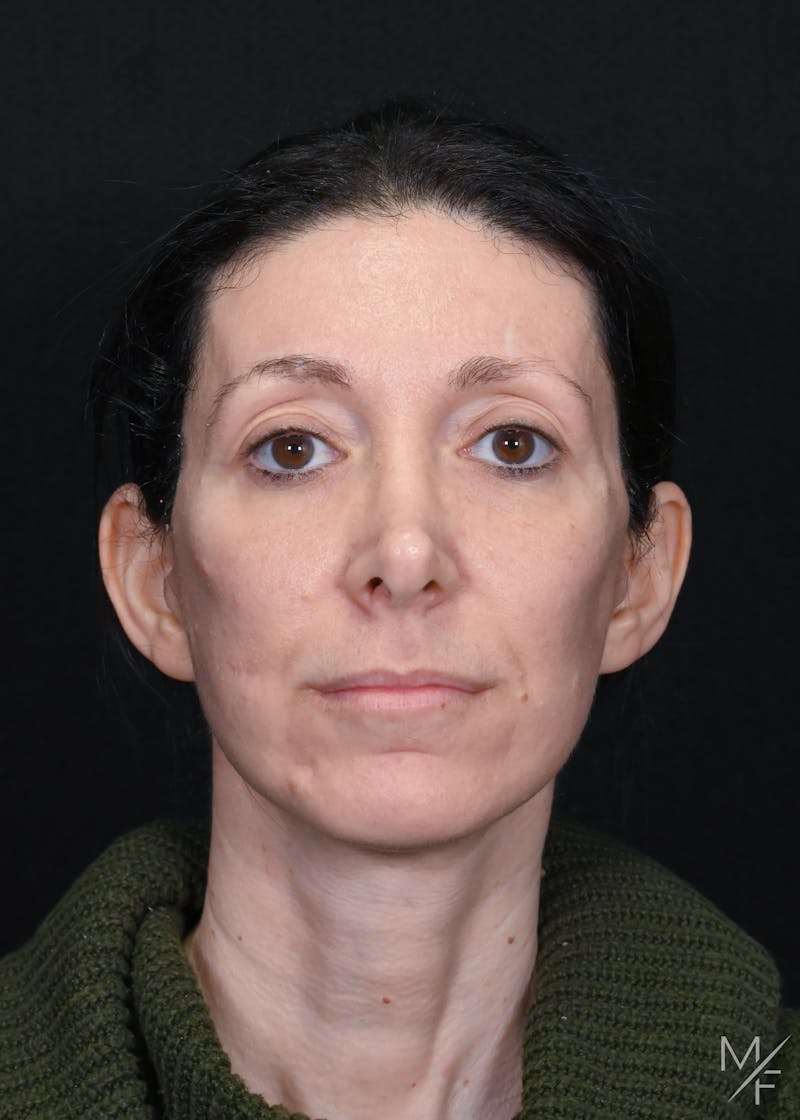 Facelift Before & After Gallery - Patient 158443 - Image 4