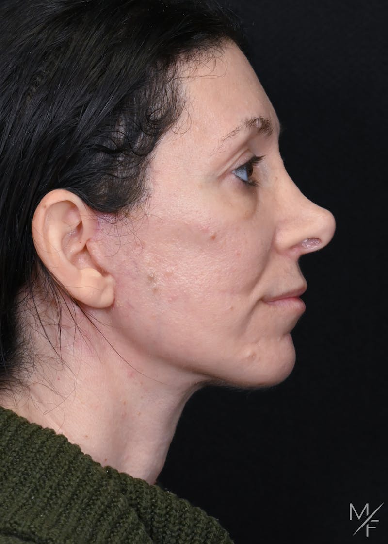Facelift Before & After Gallery - Patient 158443 - Image 6