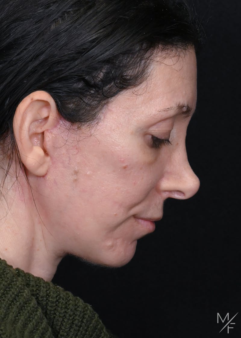 Facelift Before & After Gallery - Patient 158443 - Image 8