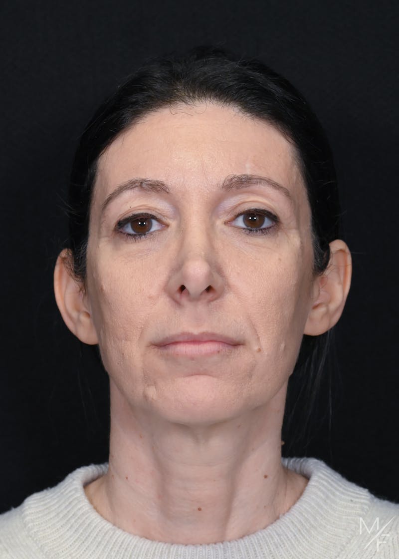 Facelift Before & After Gallery - Patient 158443 - Image 3
