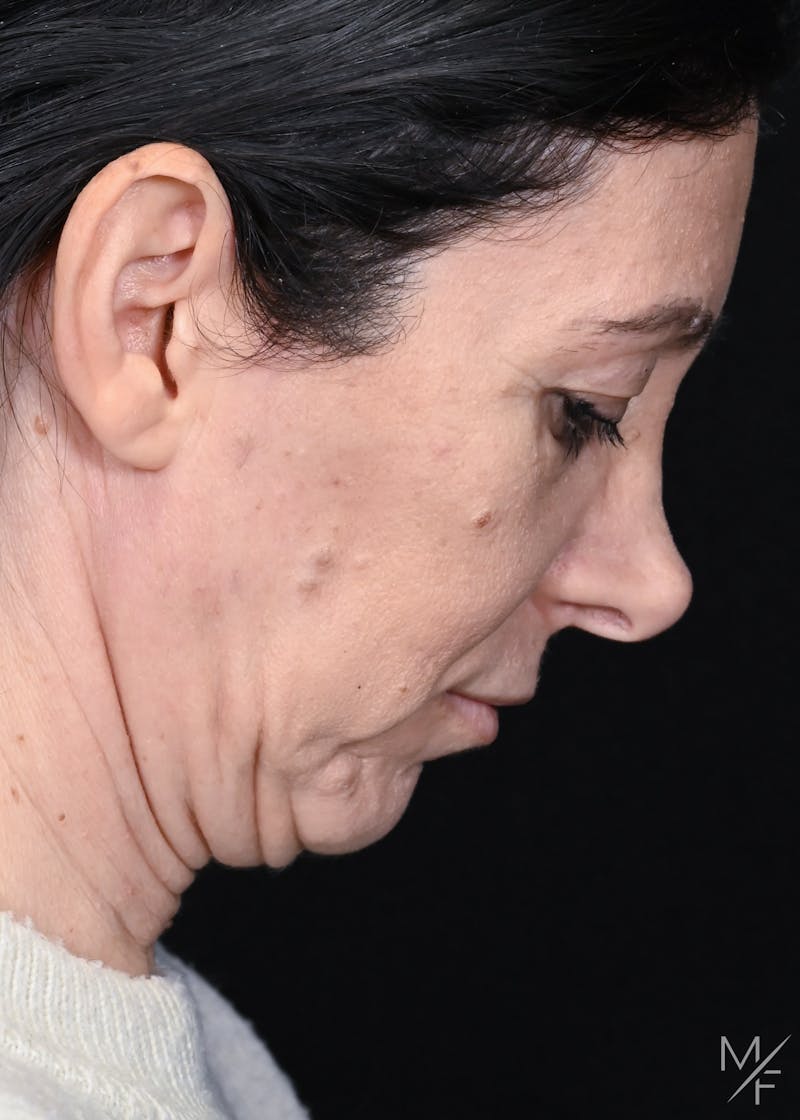 Facelift Before & After Gallery - Patient 158443 - Image 7