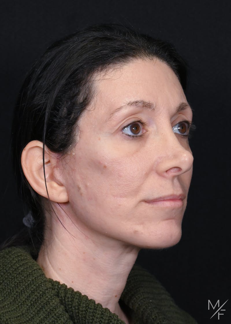 Facelift Before & After Gallery - Patient 158443 - Image 2