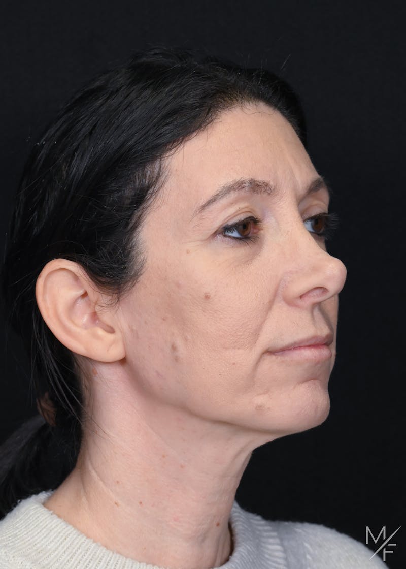 Facelift Before & After Gallery - Patient 158443 - Image 1