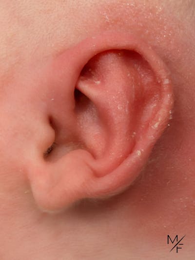 Ear Molding Before & After Gallery - Patient 242561 - Image 2