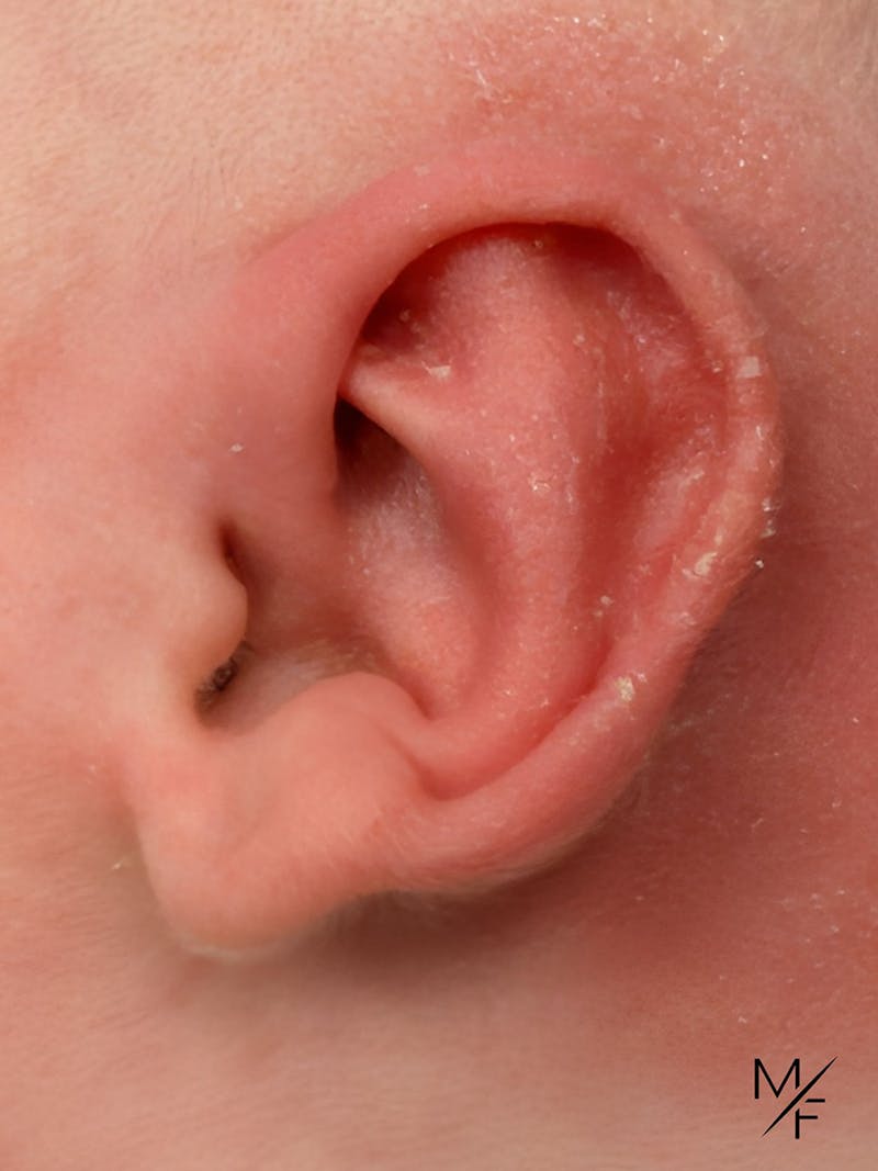 Ear Molding Before & After Gallery - Patient 242561 - Image 2