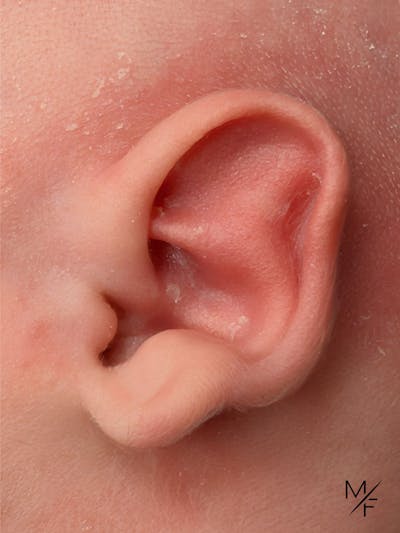 Ear Molding Before & After Gallery - Patient 242561 - Image 1