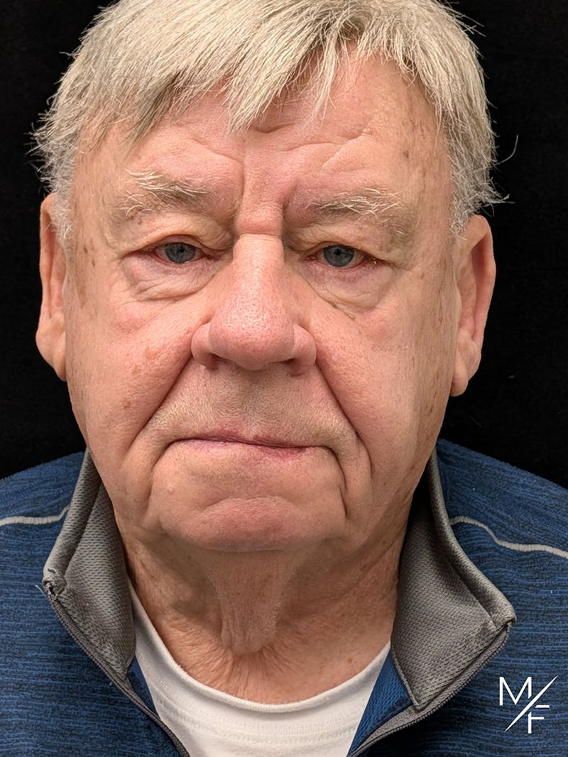 Skin Cancer Reconstruction Before & After Gallery - Patient 338302 - Image 2