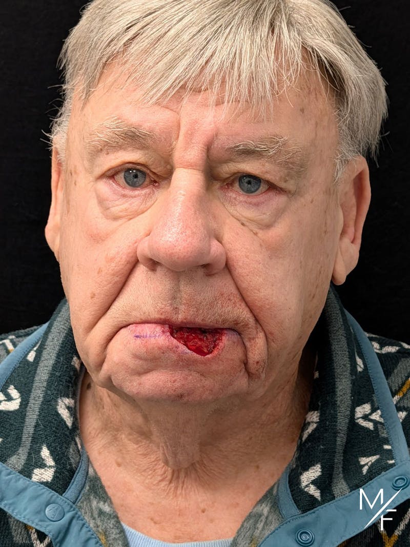 Skin Cancer Reconstruction Before & After Gallery - Patient 338302 - Image 1