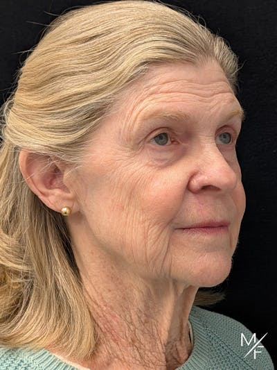 Skin Cancer Reconstruction Before & After Gallery - Patient 263701 - Image 2