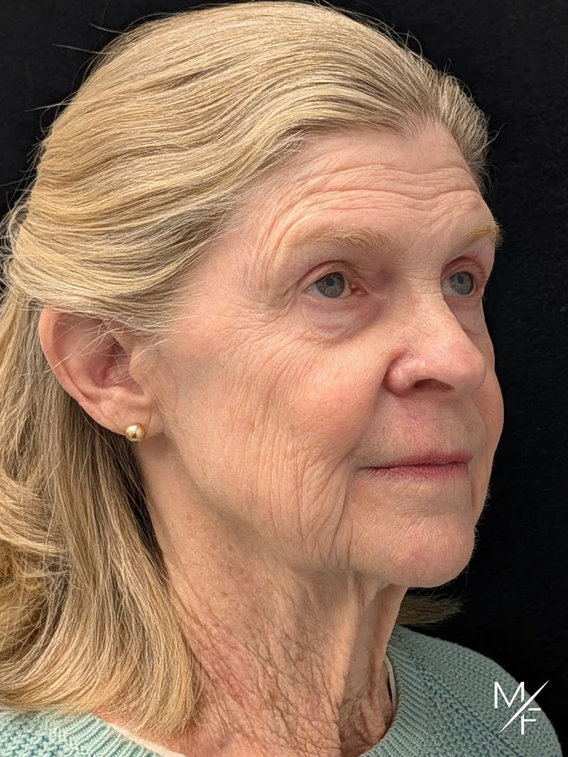 Skin Cancer Reconstruction Before & After Gallery - Patient 263701 - Image 2