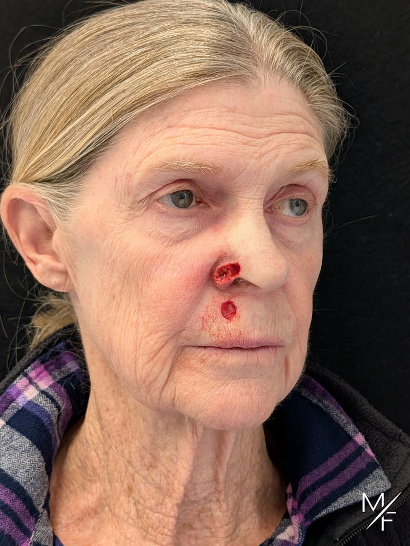 Skin Cancer Reconstruction Before & After Gallery - Patient 263701 - Image 1