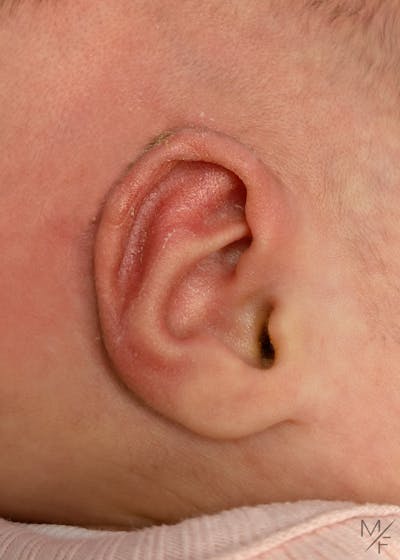 Ear Molding Before & After Gallery - Patient 203548 - Image 2