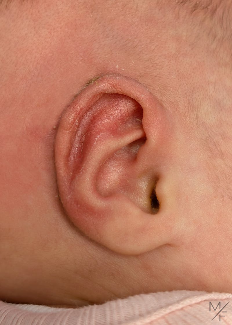 Ear Molding Before & After Gallery - Patient 203548 - Image 2