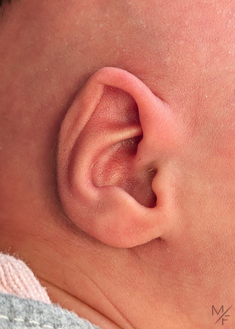 Ear Molding Before & After Gallery - Patient 203548 - Image 1