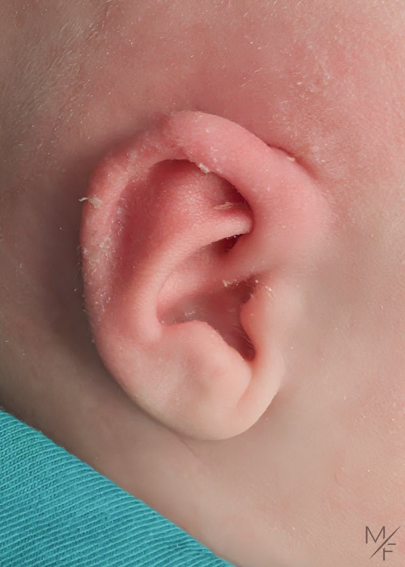 Ear Molding Before & After Gallery - Patient 406542 - Image 2