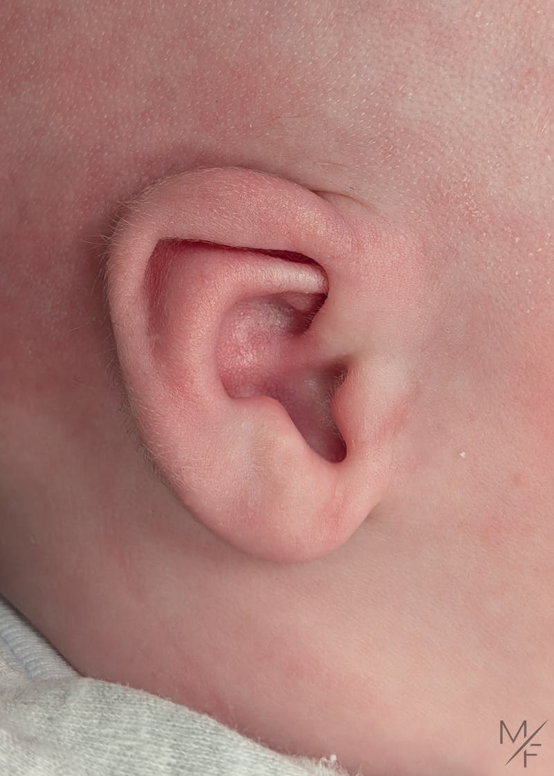 Ear Molding Before & After Gallery - Patient 406542 - Image 1