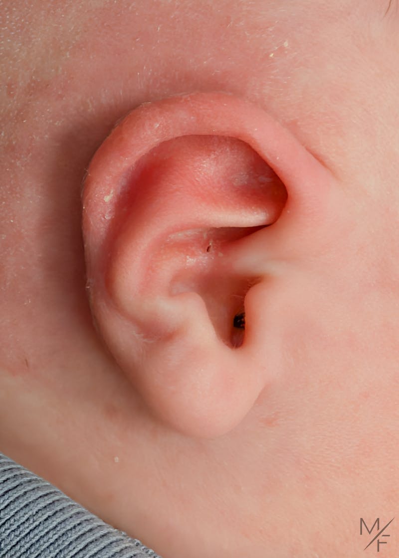Ear Molding Before & After Gallery - Patient 778739 - Image 2