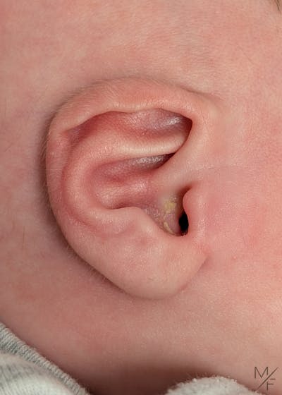 Ear Molding Before & After Gallery - Patient 778739 - Image 1
