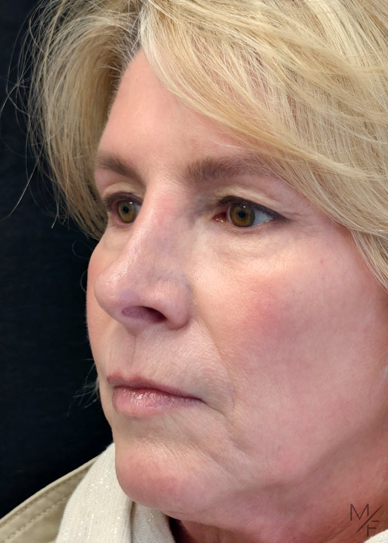 Skin Cancer Reconstruction Before & After Gallery - Patient 347613 - Image 2
