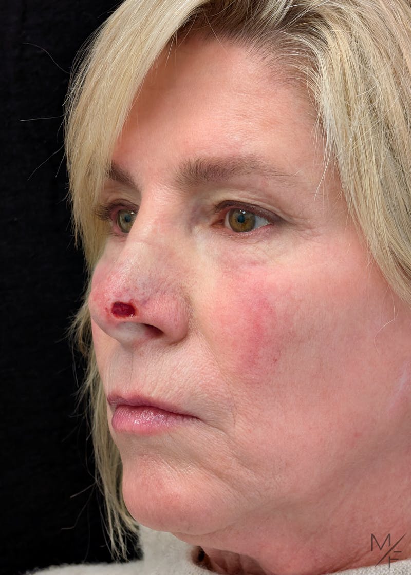Skin Cancer Reconstruction Before & After Gallery - Patient 347613 - Image 1