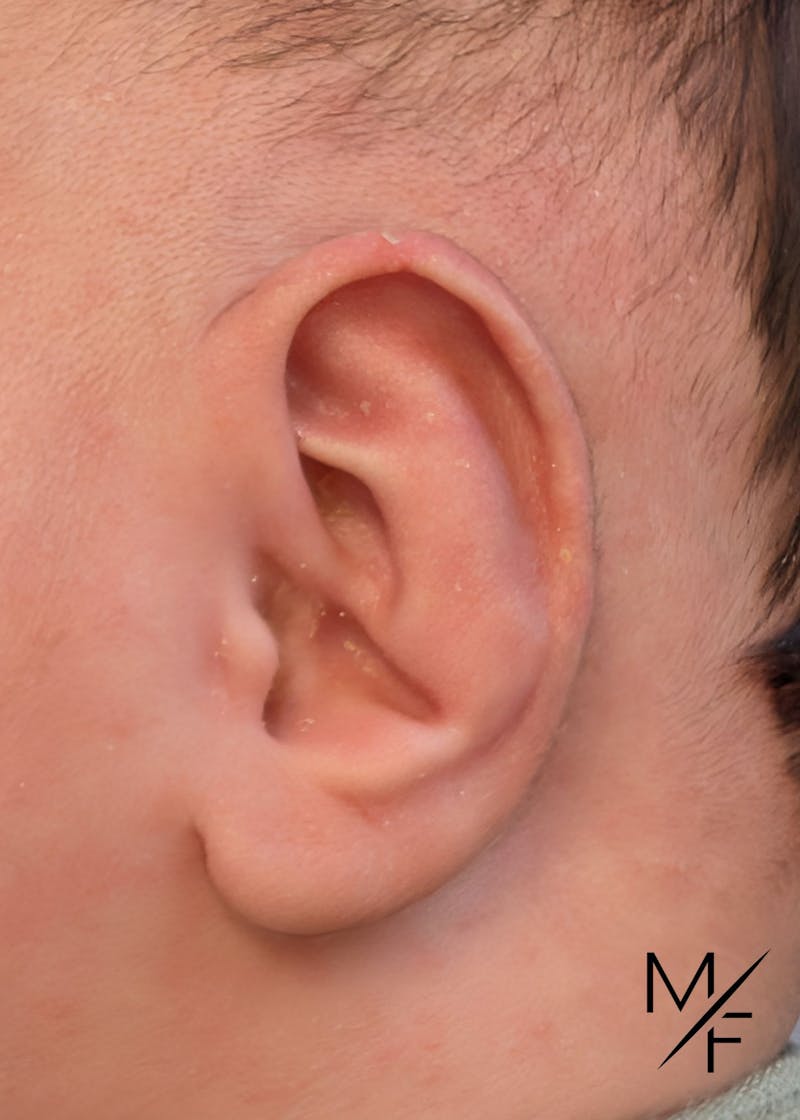 Ear Molding Before & After Gallery - Patient 408948 - Image 2