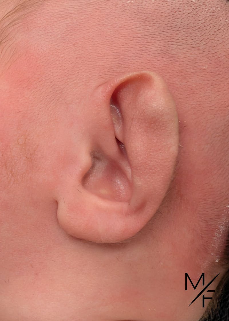 Ear Molding Before & After Gallery - Patient 408948 - Image 1